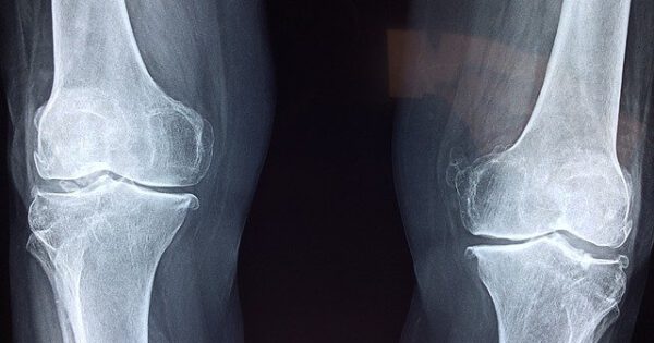 Post-Surgical Joint Replacement Precautions and Tips