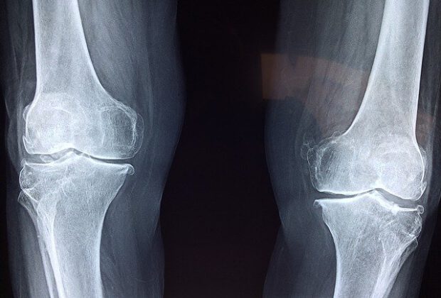 Post-Surgical Joint Replacement Precautions and Tips